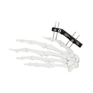 Producto 9 Minifijador de bajo perfil para cirugía de la palma del dedo