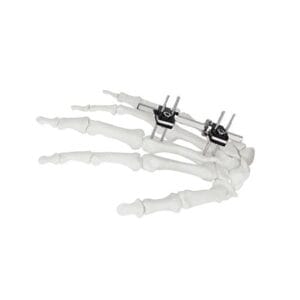 Producto 8 Fijador óseo de precisión para aplicaciones dedo-palma