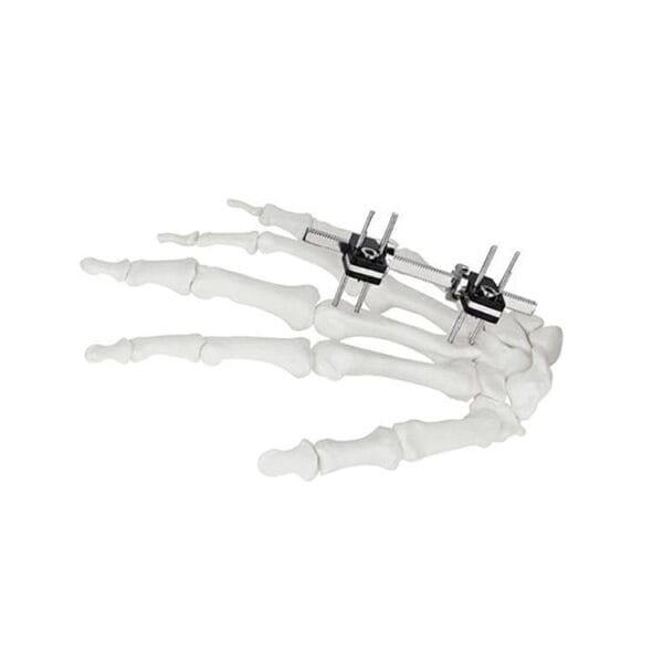 Precision Bone Fixator for Finger Palm Applications