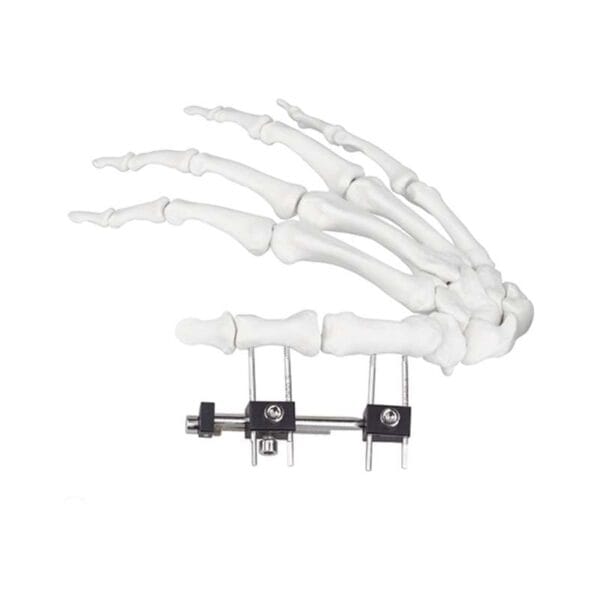 Mini Fixador Tipo A – Fixador Externo Confiável para Fraturas de Dedos e Palmas