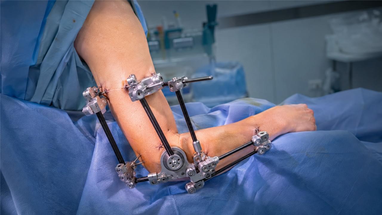 Articulating external fixator on elbow joint showing hinged design that maintains joint motion during periarticular fracture healing