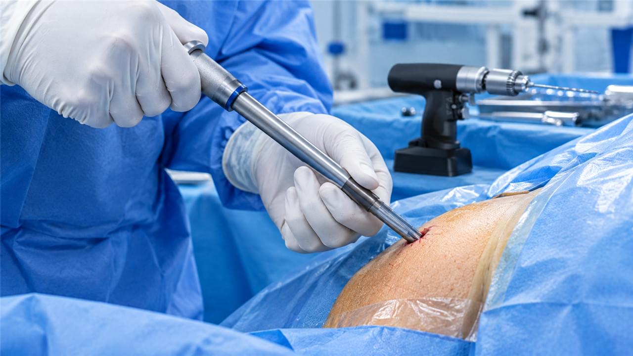 Le guide complet de la fixation externe mini-invasive : 5 étapes pour une guérison plus rapide 2 Technique d'insertion de fixateur externe mini-invasif utilisant un manchon de protection des tissus mous pour le placement de broches percutanées